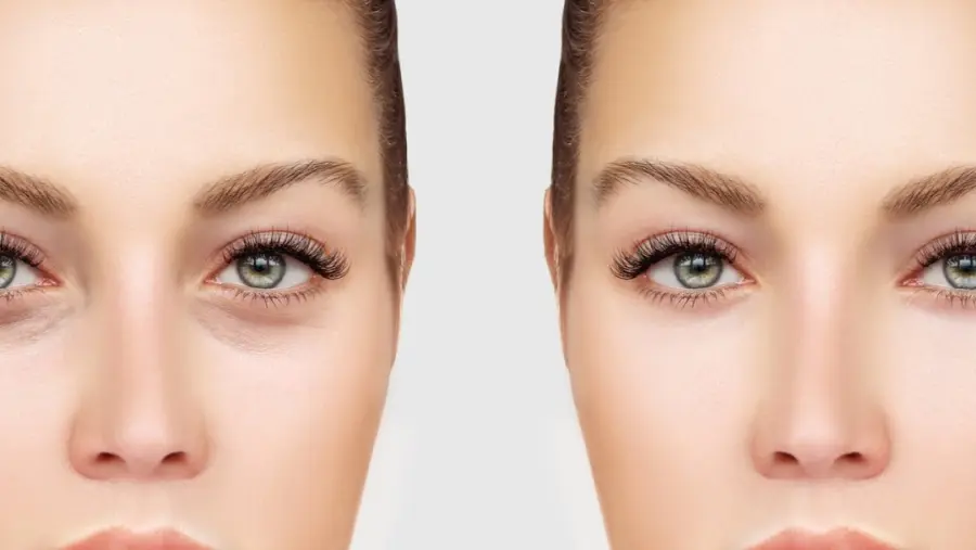 Blefaroplastica Milano