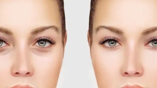 Blefaroplastica Milano