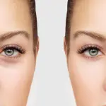 Blefaroplastica Milano
