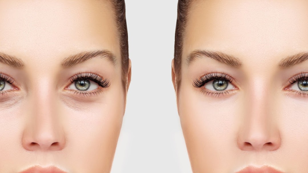 Blefaroplastica Milano