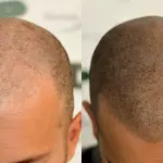 A cosa serve tricopigmentazione Milano